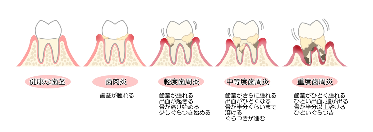 歯周病の症状
